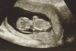 US-2 (12 Weeks)