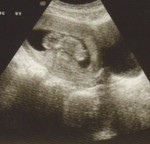 US-3 (12 Weeks)