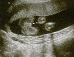 ItsAGirl-20Weeks
